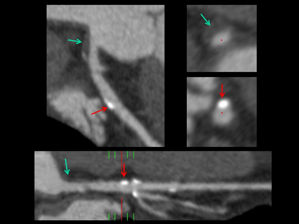 Fig. 14: Excentric, non-calcified plaque at the level of the LMCA (blue arrow) generating a < 50% lumen stenosis.