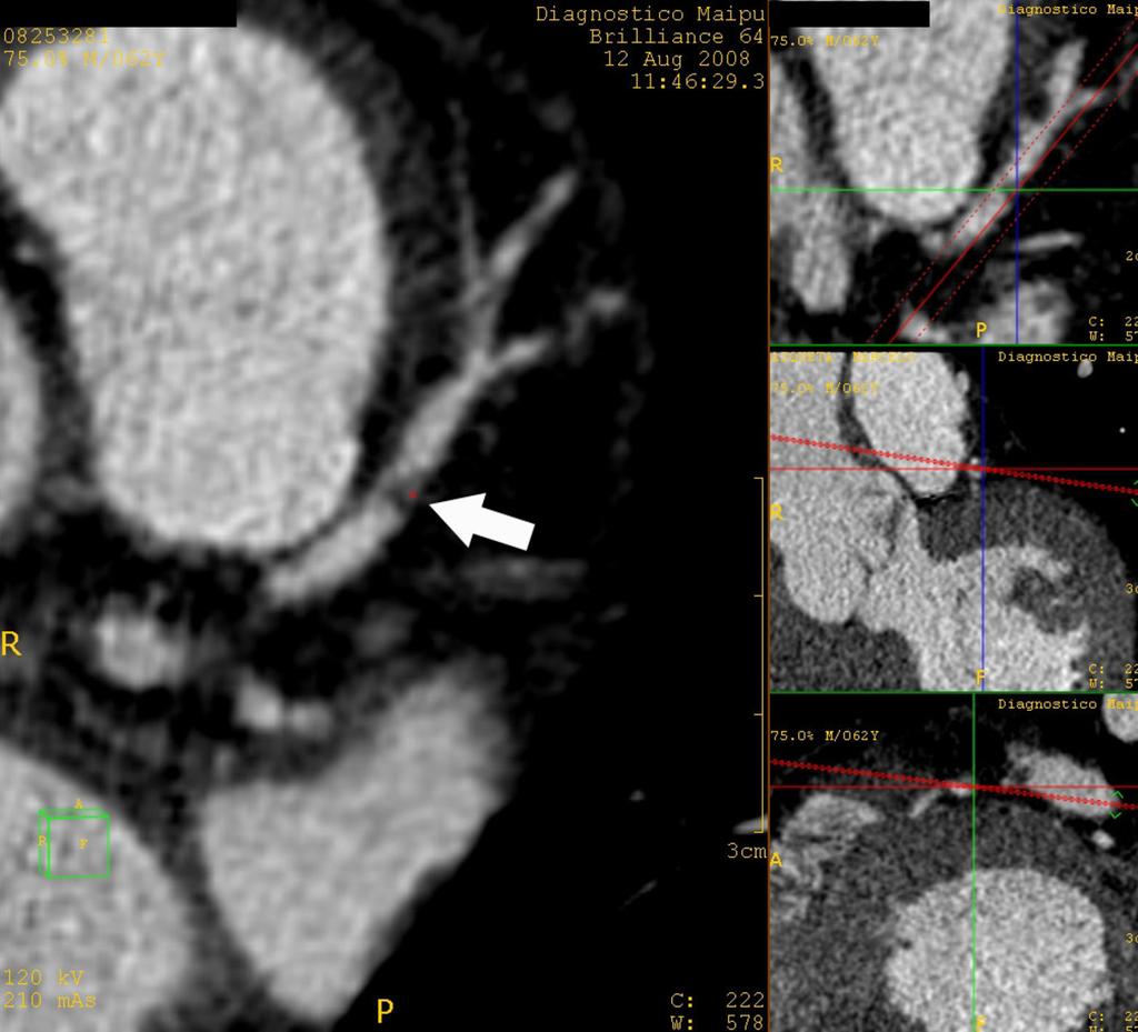 Fig. 15: Focal non-calcified plaque at the proximal segment of