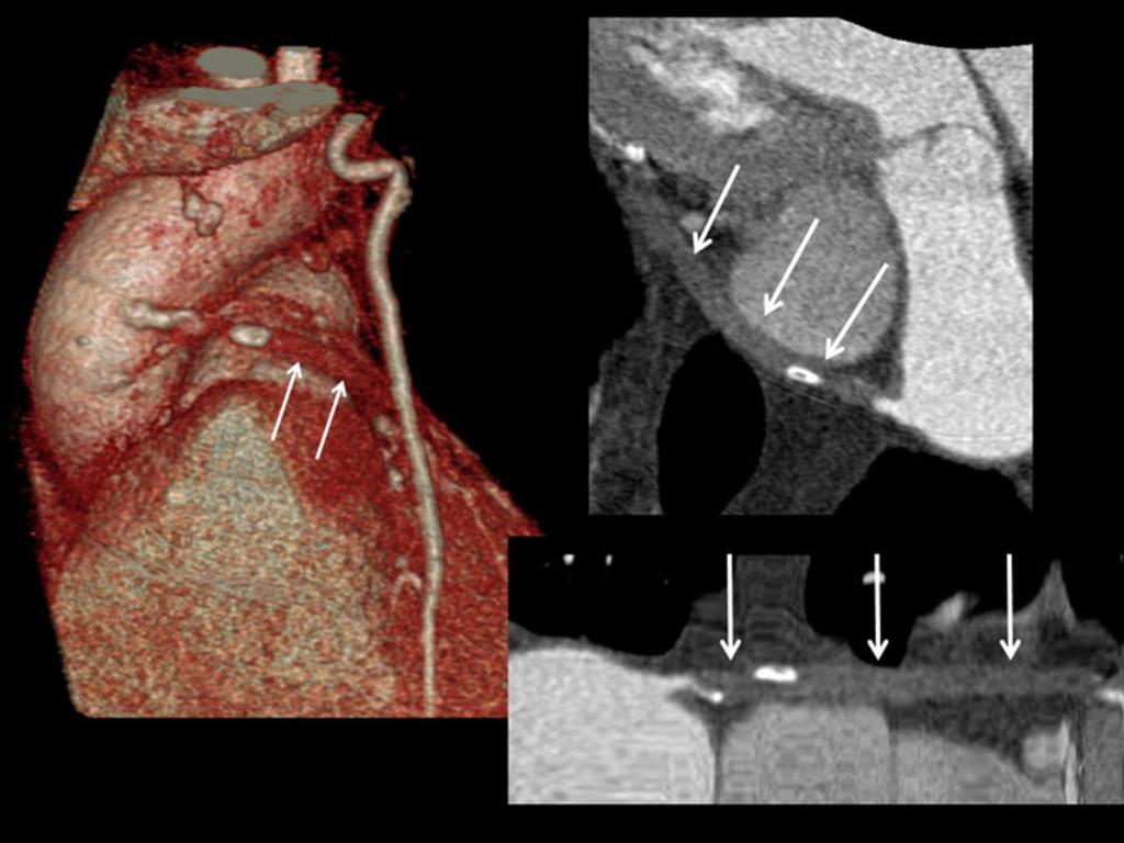 Fig. 20: Total oclussion of a venous coronary artery bypass graft