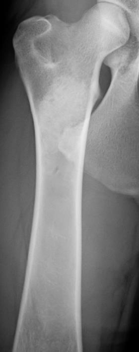 osteoarthritis of the elbows, knees and smaller joints or