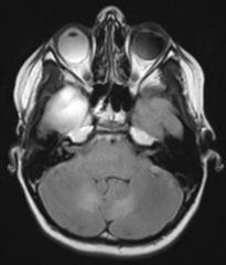 Clinical Presentation MRI findings T1 Post contrast 10 year-old girl presented with 2 month history of intermittent episodes of