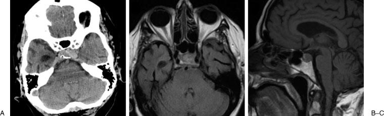 100 SKULL BASE REPORTS/VOLUME 1, NUMBER 2 2011 Figure 1 Preoperative imaging of patient 1. (A) Axial CT image obtained preoperatively after onset of headaches showing a mixed hyperdense sellar lesion.