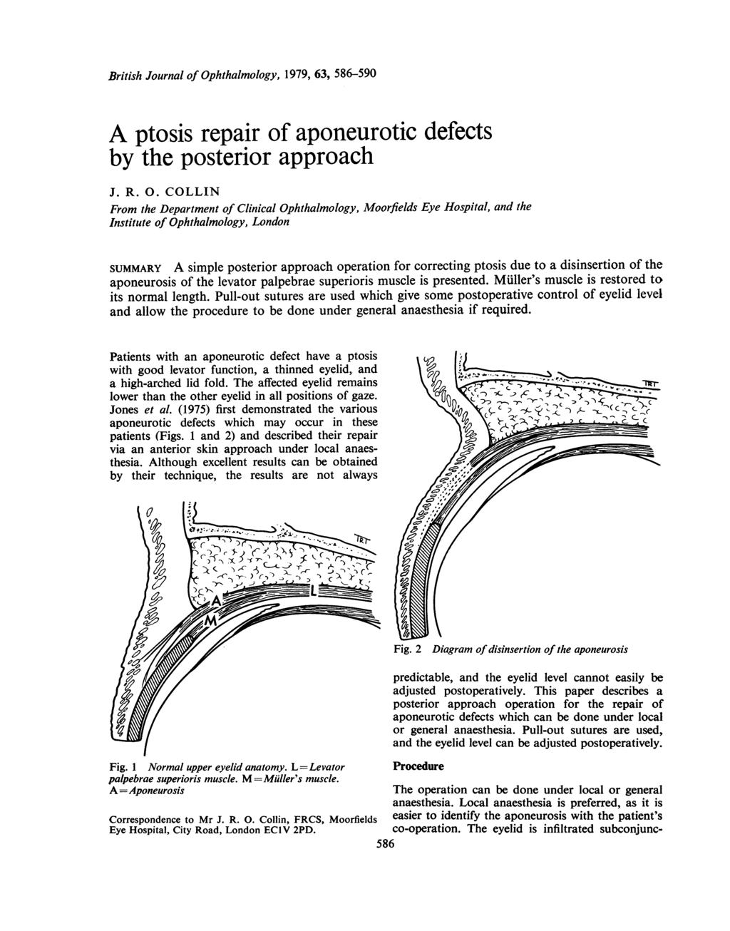 British Journal of Ophthalmology, 1979, 63, 586-590 A ptosis repair of aponeurotic defects by the posterior approach J. R. 0.