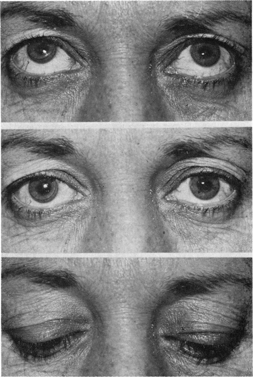 The contour of the eyelid is then adjusted by the positioning of the medial and lateral sutures.