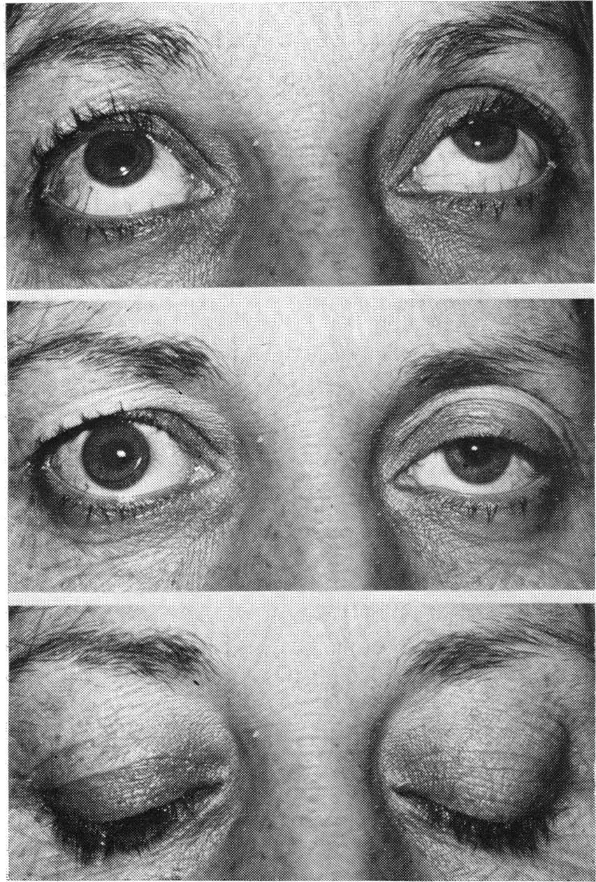 The time of suture removal is governed by the height of the eyelid postoperatively.