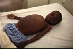 Neglected Diseases & needs (for Diseases Malaria