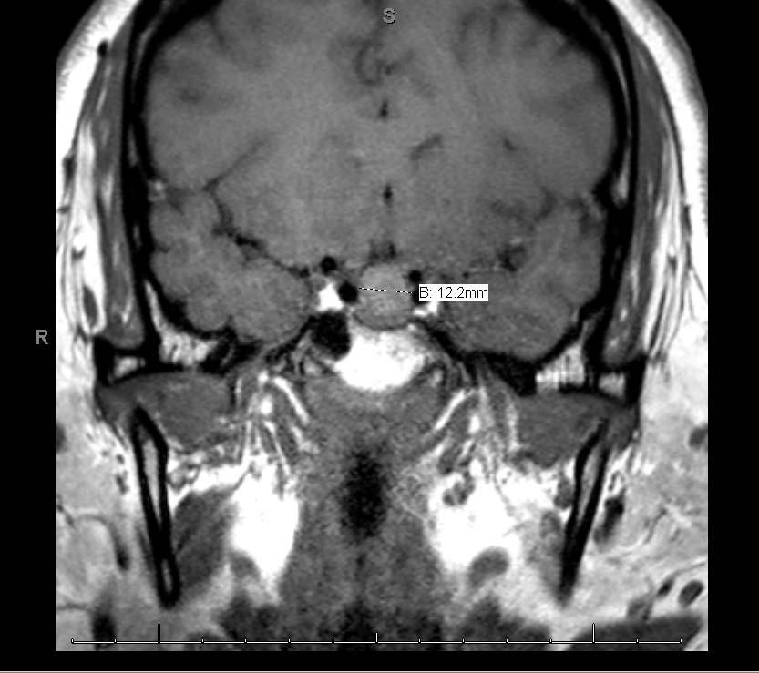 MRI: Area of acute