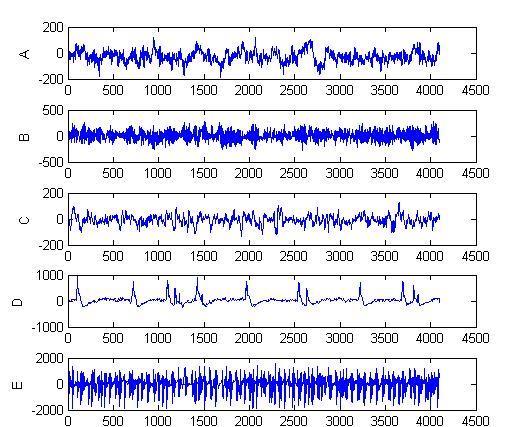 42 Qualitative and Quantitative Evaluation of EEG Signals in Epileptic Seizure Recognition exists in temporal lobe and perhaps other forms of epilepsy.
