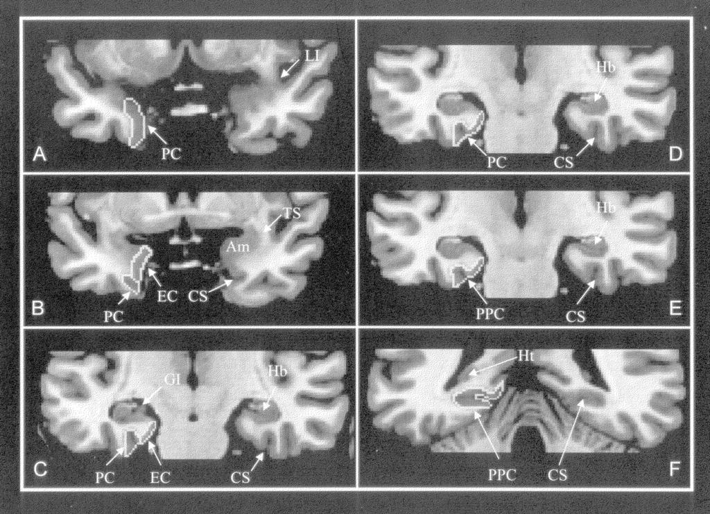 BERNASCONI et al.: MRI ANALYSIS IN TEMPORAL LOBE EPILEPSY 497 FIGURE 1. Major anatomical boundaries of parahippocampal region structures on coronal MR images.