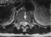 day) b:t2wi sagittal section ; Spinal cord infarction (White arrow) c:t2wi transverse
