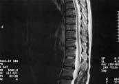 postoperative day) ; The spinal cord infarction decreased a c b d CSFP 40mmHg 30ml