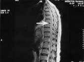 postoperative day) b:t2wi sagittal section ; Spinal cord ischemic