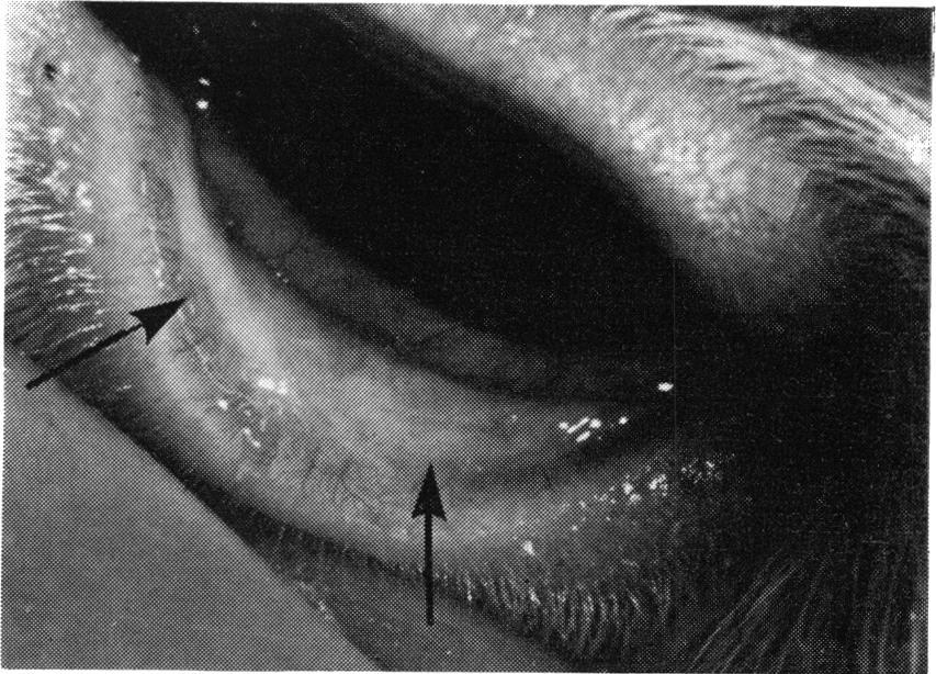 During later infections and oedema of the upper palpebral and bulbar persiste folong er( Dring teinfec conjunctivae.