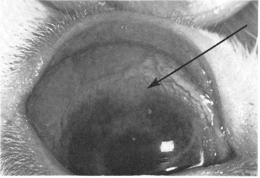 These were first observed several months after the seventh infection. A notch developed on the left lower lid which was associated with synechial scarring (Figs.