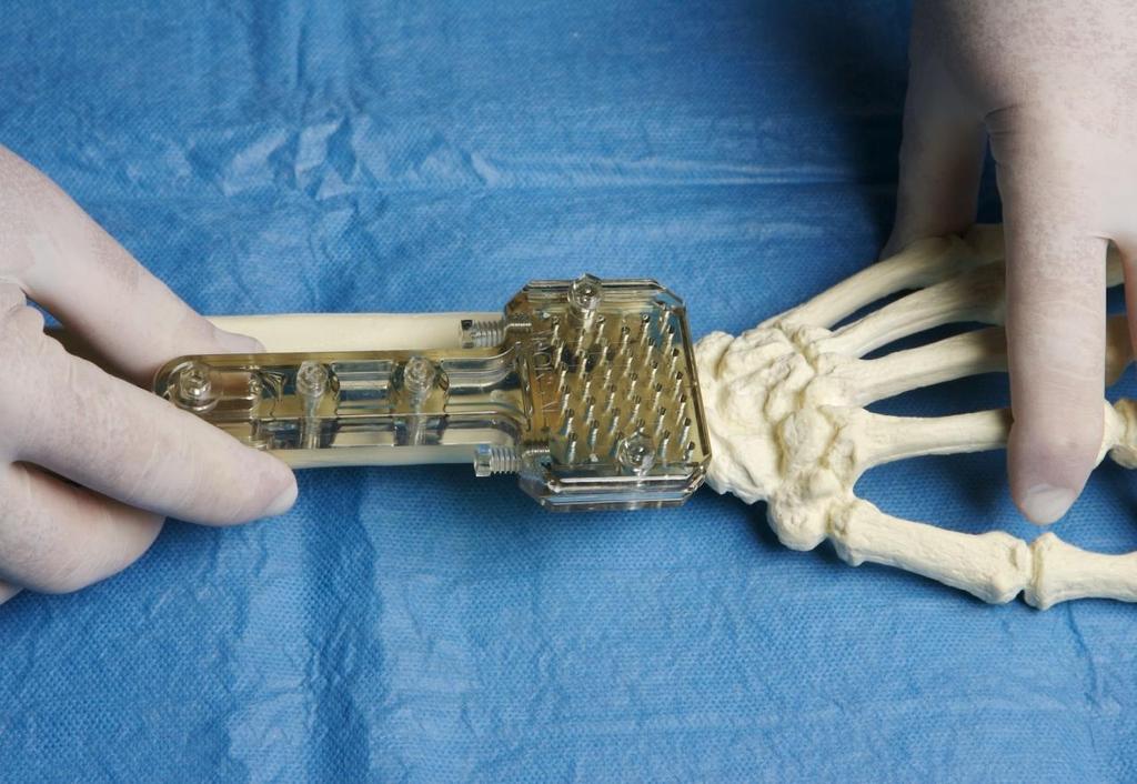 Position the NBX fixator body over the distal radius to act as a template for the insertion of all K-wires and half-pins, with the distal row of holes over