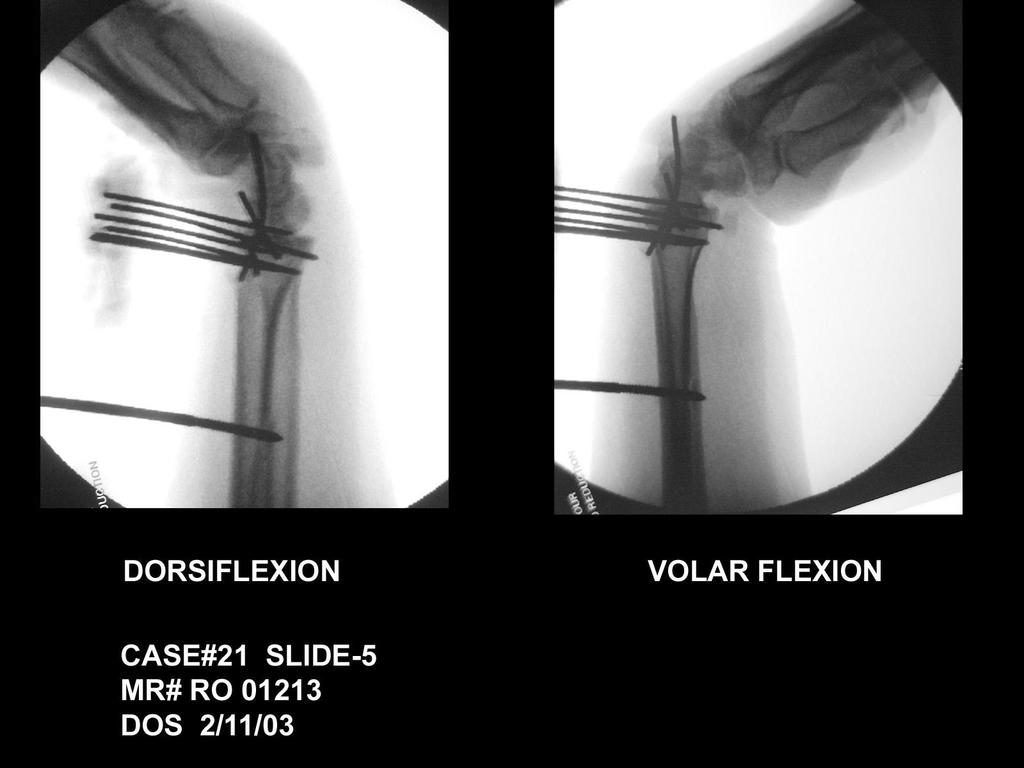 Prior to waking the patient up, and after removing the arm from the First Assistant, the surgeon MUST place the wrist through a full range of motion: Volar and dorsal felxion Radial and Ulnar