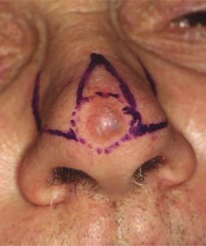 Skin Cancer 3 (a) (b) (c) (d) (e) Figure 1: (a) BCC involving nasal tip: flap design. (b) Tumour resection. (c) Intraoperative view: modified bilateral nasalis flap.