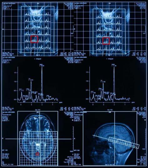 Visual Stimulation, 1H-MR Spectroscopy and fmri of the Human Visual Pathways 115 CSI occipital: visual cortex.