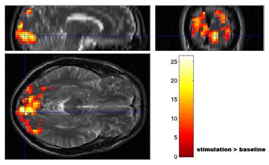 Visual Stimulation, 1H-MR Spectroscopy and fmri of the Human Visual Pathways 117 Figure 6.