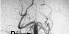 CT Angiogram DSA Minimally invasive; uses iodinated