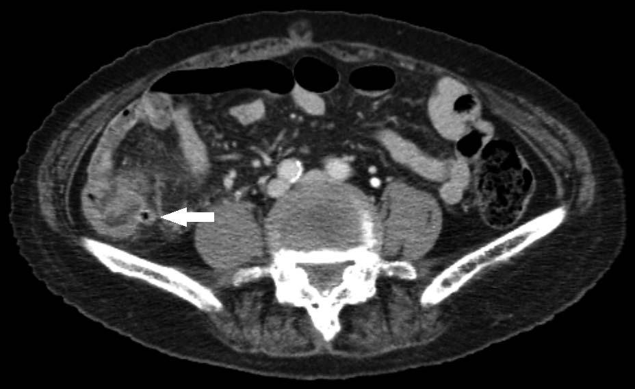 Fig. 3 Gross photograph of ileocecectomy of case 2. An ostium of diverticulum (arrow) is seen in the terminal ileum and the adjacent mucosa showed inflammation (dotted line, ileocecal valve). Fig.