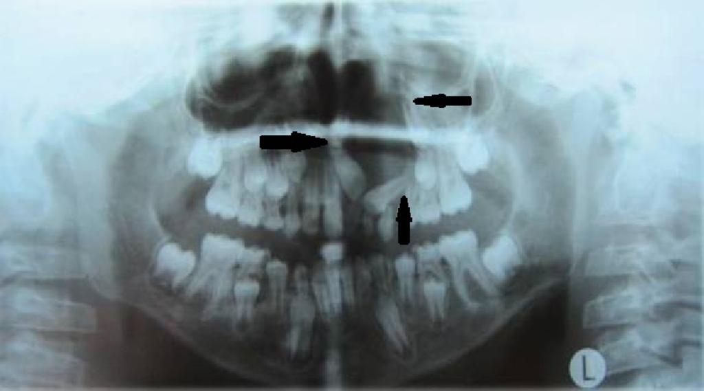 FIGURE 2: Orthopantomogram shows a cyst involving the left maxilla with an impacted central incisor, lateral incisor, and canine The paranasal sinus (PNS) view revealed radiolucency extending
