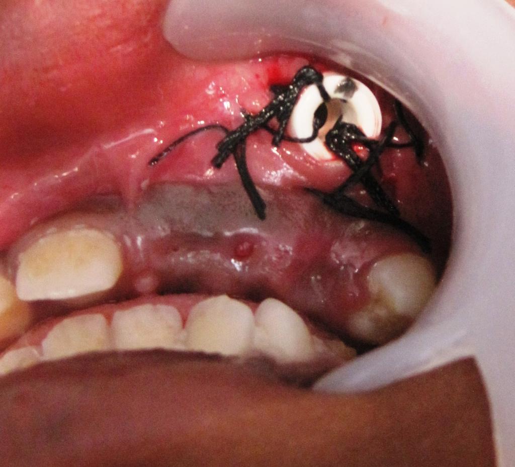 FIGURE 6: Suction catheter in place, secured with sutures The histopathological report obtained confirmed the diagnosis of a dentigerous cyst.