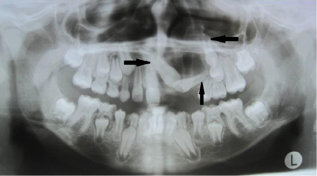 So, during a subsequent visit, the patient was referred to the department of orthodontics for the assistive eruption of permanent teeth into the dental arch