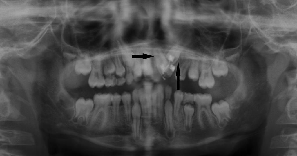 Initially, brackets were bonded on the central and lateral incisors and the canine and the flap was closed. Strap-up was done with 0.016 Niti wire.