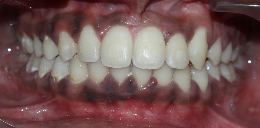aligned permanent dentition 2018 Moturi et al.