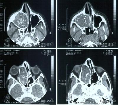 Figure 2 Figure 2: Preoperative axial computed tomography scans demonstrating a soft tissue mass medial to the left orbit which was consistent an expanding mucocele.