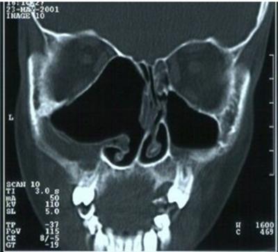 Figure 4 Figure 4: Postoperative coronal CT scans of sixth month demonstrating a large ethmoidomaxillary cavity.