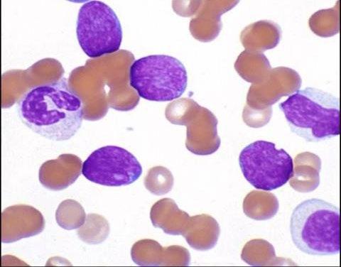 Chronic myeloid leukemia, BCR-ABL1 positive: Updates Name change from WHO 4 th edition (2008) myeloid New definition of lymphoid blast crisis Any lymphoblast(s) in the PB raise concern for