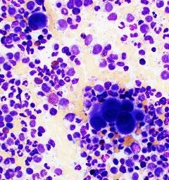 Chronic myeloid leukemia, Most often diagnosed in