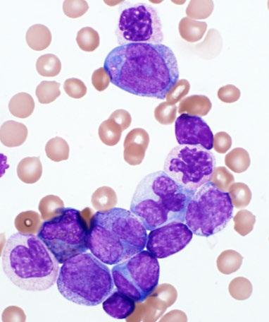Chronic myeloid leukemia, Disease progression Evidence of morphologic evolution Evidence of laboratory