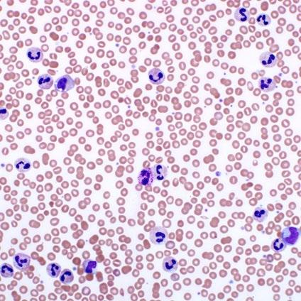 Chronic neutrophilic leukemia Peripheral blood white blood cell count >25 x 10 9 /L Segmented neutrophils plus banded neutrophils constitute >80% of the white blood cells Neutrophil precursors