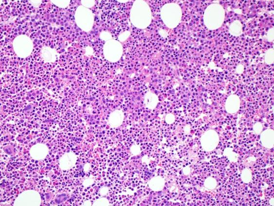 Chronic neutrophilic leukemia Hypercellular bone marrow Neutrophil granulocytes increased in
