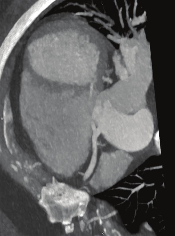 2 Case Reports in Vascular Medicine (a) (b) Figure 1: Cardiac computed tomography showing anomalous left main off of the right sinus of Valsalva and subsequent intraseptal course.