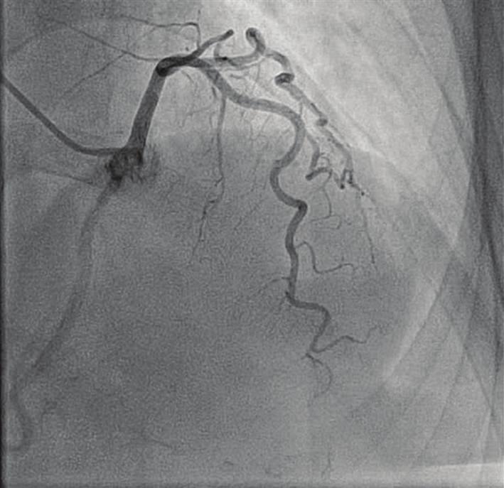 (Figure 1). Invasive coronary angiography (Figure 2) was completed with normal fractional flow reserve measurements in the proximal left anterior descending with adenosine infusion.
