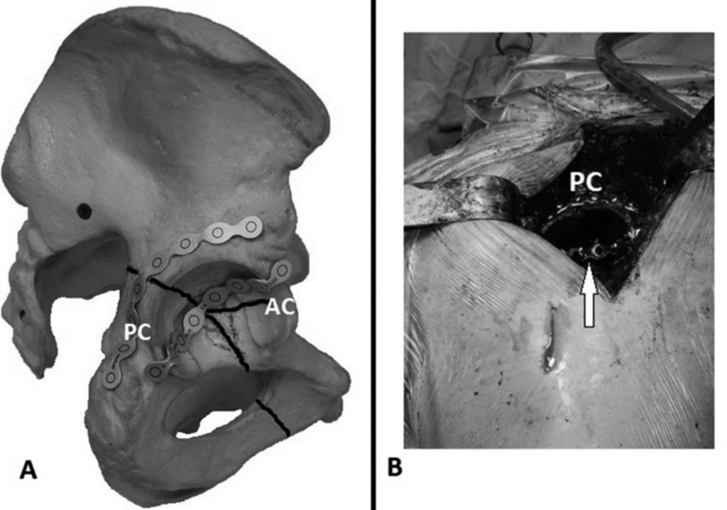 primary total hip arthroplasty after acetabular fracture 95 Fig. 2.