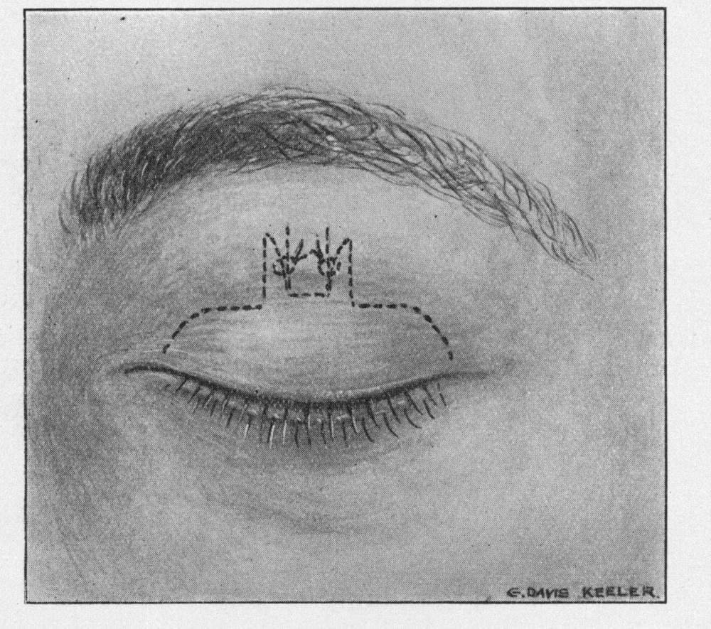 OPERATION FOR THE RELIEF OF CONGENITAL PTOSIs 745 A decided advantage is gained, firstly, by using strips of tarsus as the lid attachment, and secondly, by joining these strips to the sides of the