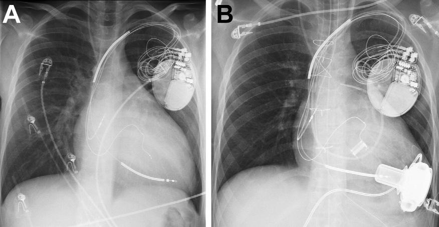 Ann Thorac Surg MIERA ET AL 2011;91:1256 60 HEARTWARE VAD IN CHILDREN 1259 Fig 2. Chest roentgenogram of patient 3 (A) pre-implantation and (B) post-implantation. deficit [6].