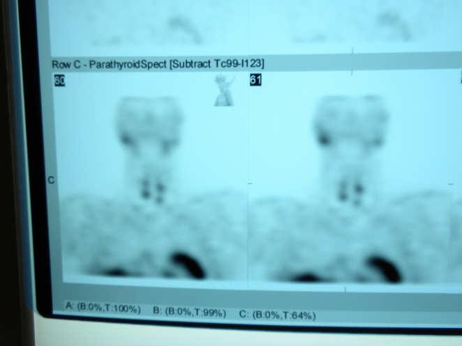 Sestamibi Iodine Subtraction Scan with SPECT Imaging