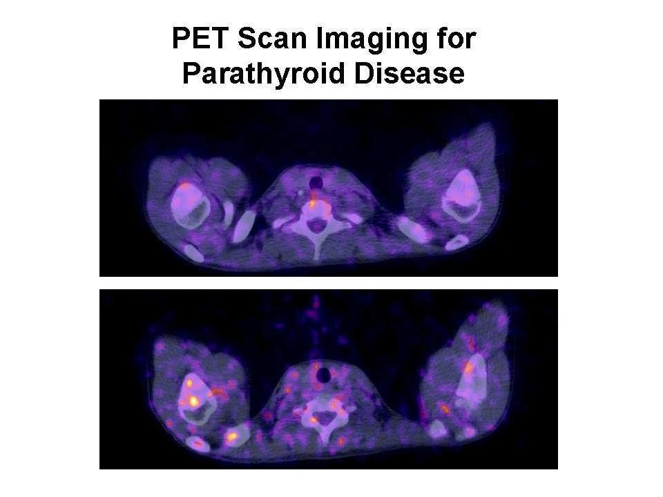 Radionuclide imaging for hyperparathyroidism (HPT): Which is the best technetium-99m sestamibi modality?
