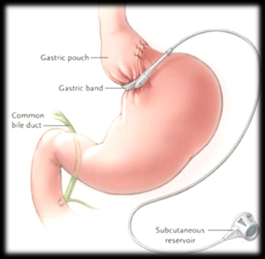 Laparoscopic Adjustable Gastric Band Purely restrictive Highest weight regain May be appropriate in those who want less invasive surgery or less weight loss Multiple adjustments