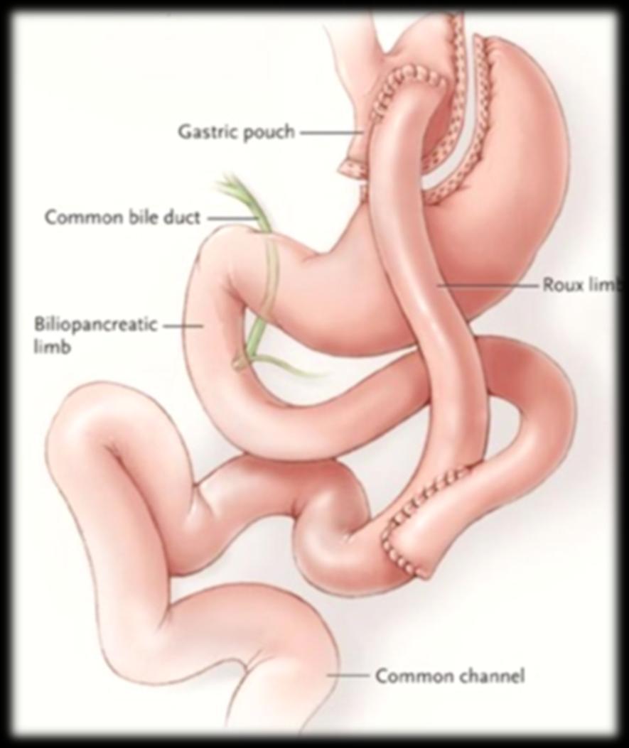 Roux-En-Y Gastric Bypass Restrictive and malabosorptive Gold Standard Complications Early: Stricture Marginal Ulcer DVT most common cause of mortality in perioperative period Thiamine Deficiency With