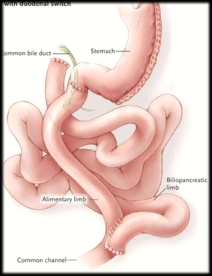 T. Biliopancreatic Diversion with/without Duodenal Switch Malabsorptive Least commonly performed due to severe long term side effects Complications Early GI Leak Roux limb obstruction Complications