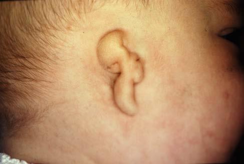 The condition is a complex mix of cosmetic, functional, and often psychological difficulties. Microtia: Not only the ear.
