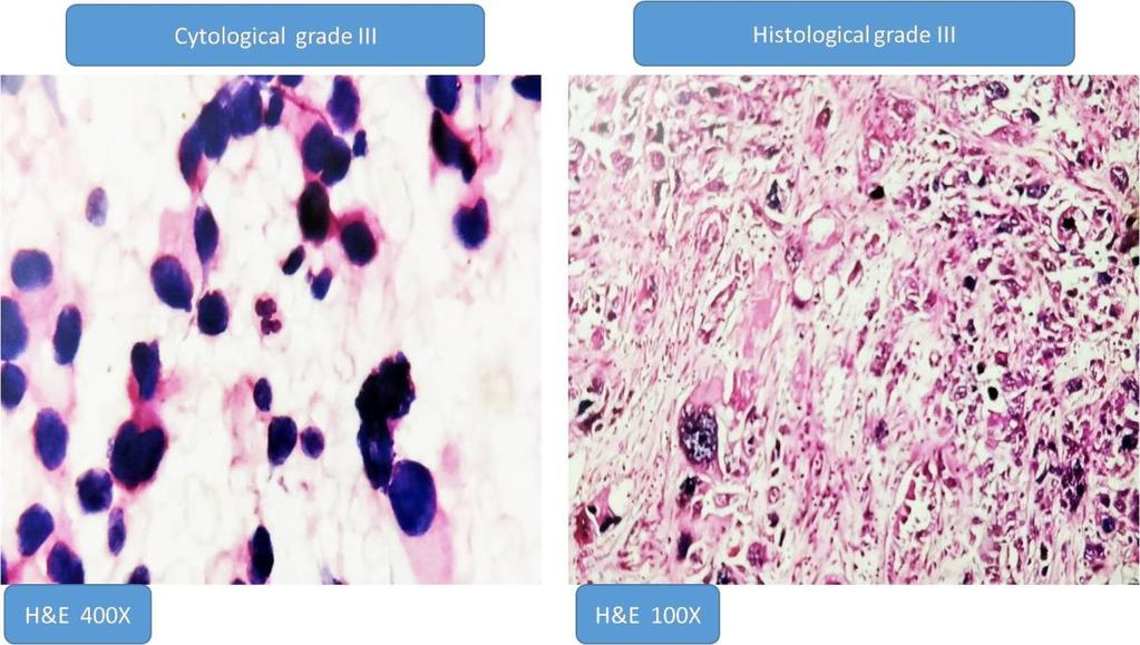 Figure 3: Grade III cytological and histological microscopic pictures V.