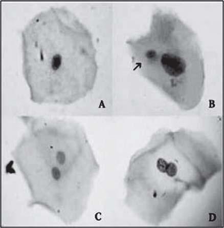 Figure 3: Pathways that are postulated to produce extra-articular DNA-containing bodies Fig 4: Nuclear anomalies seen along with micronuclei in exfoliated cells Fig 5: A: Normal buccal mucosa B: Cell